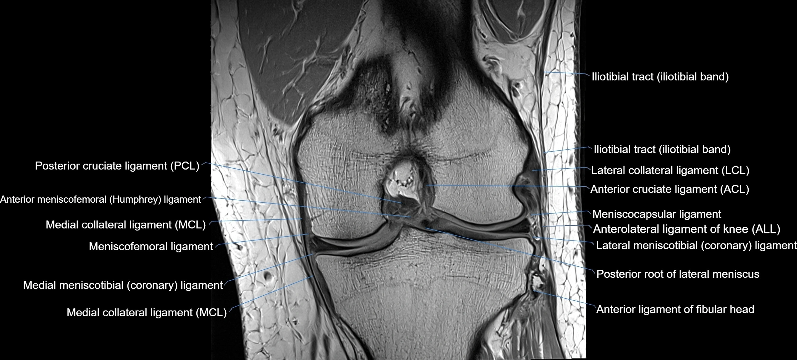 MRI coronal  ligaments cross sectional anatomy 3T  radiology  image-img-04001-00023.webp